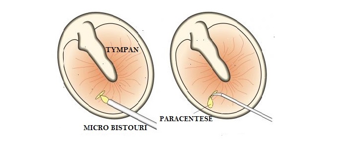 LA PARACENTESE DU TYMPAN OU MYRINGOTOMIE